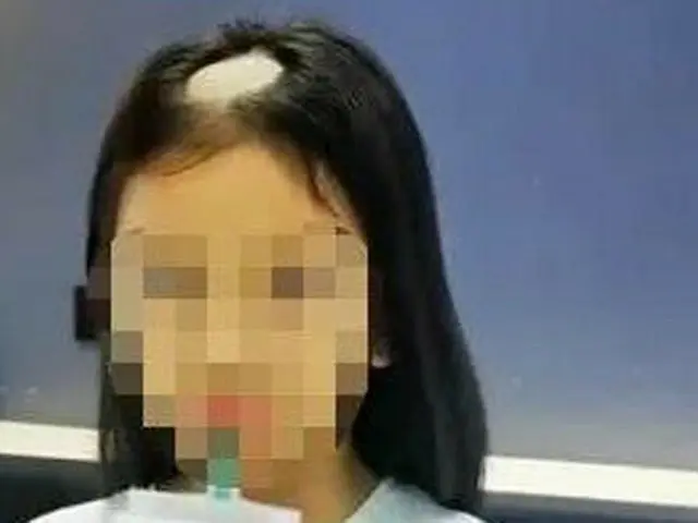 ในประเทศจีนเด็กผู้หญิงคนหนึ่งที่ป่วยเป็นโรคผมร่วงได้แพร่กระจายอย่างเห็นได้ชัดภาย