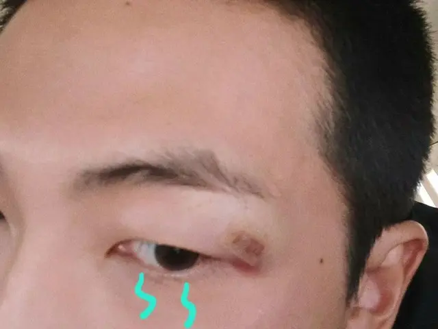 แฟนๆ RM กังวลหลังจากเผยรอยแผลเป็นใต้คิ้วของเขา